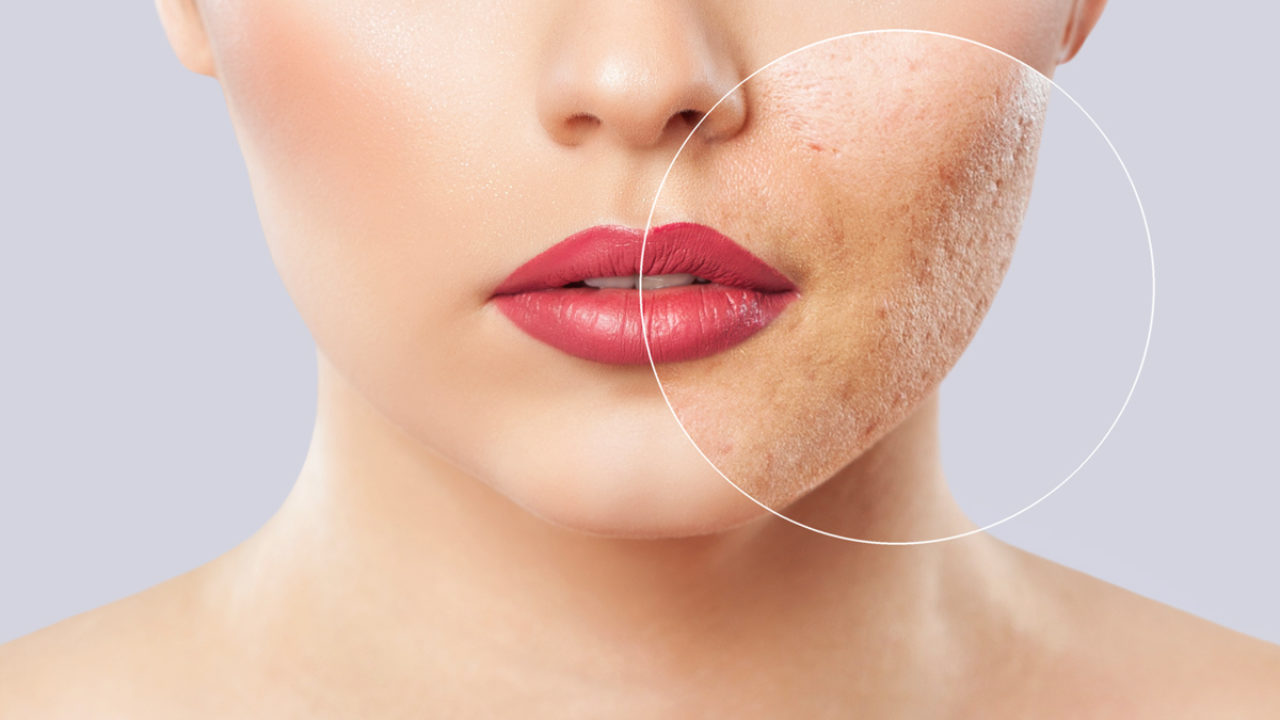 Combattere l'acne: consigli e prodotti per curare la pelle - Farmae Magazine