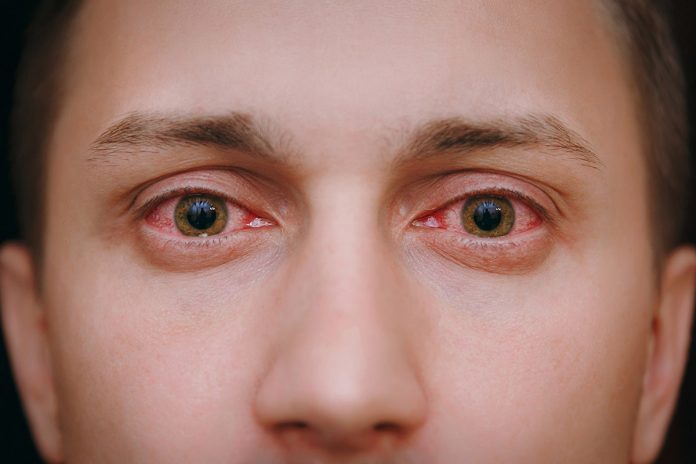 Occhi arrossati: sintomi, cause e rimedi